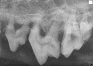 Xray of periodontal disease