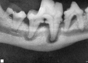 Xray of periodontal disease