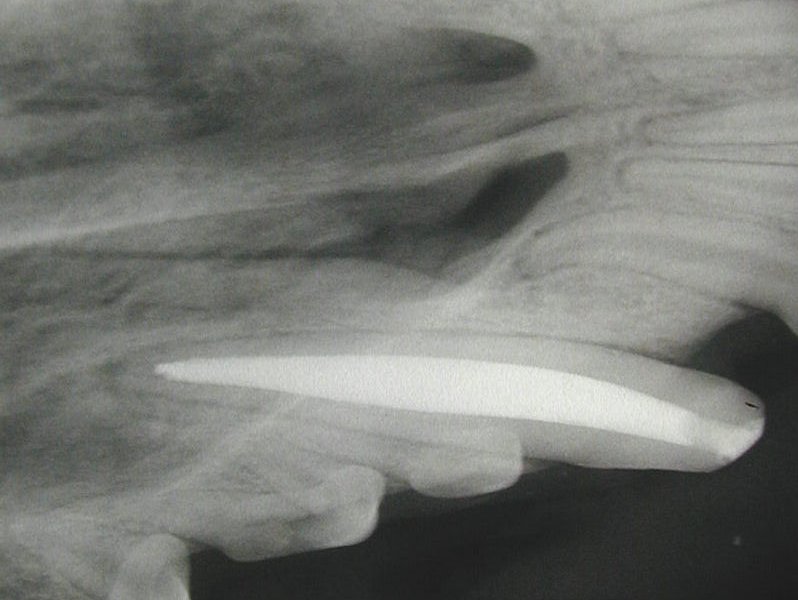 Tooth Radiograph