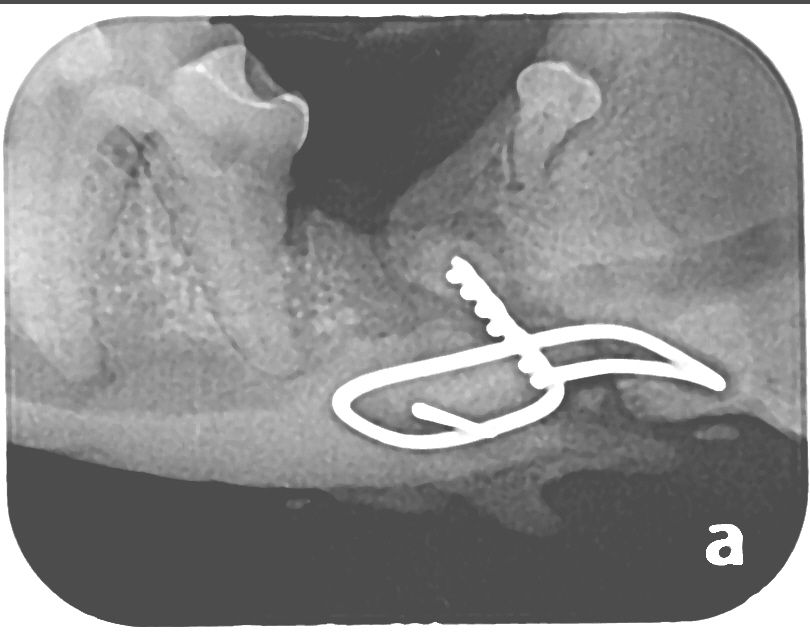 Wire jaw fracture repair
