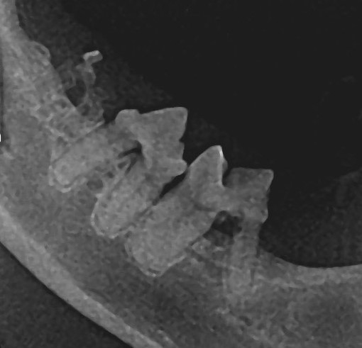 tooth resorption 