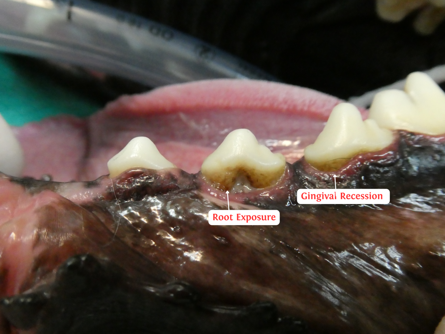 periodontal disease 